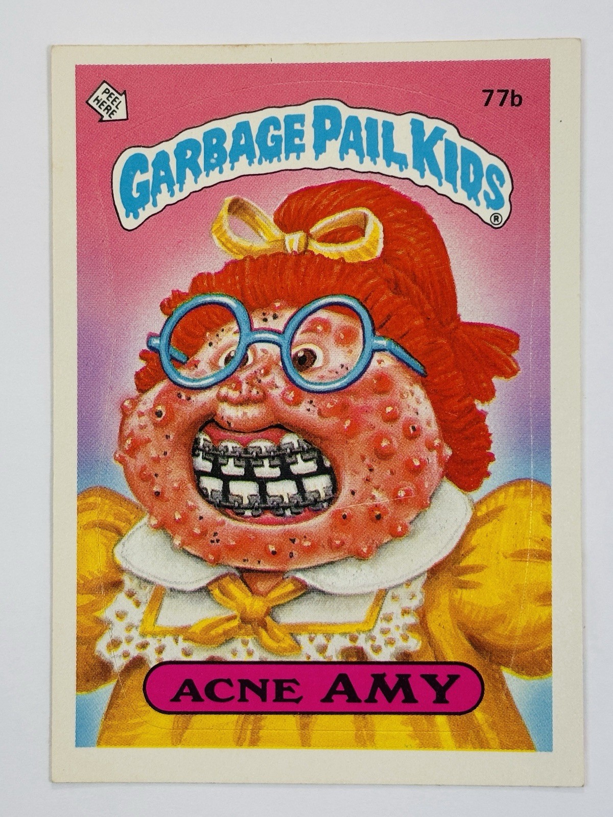 1985 Topps Garbage Pail Kids -Series 2 -Glossy #77b ACNE AMY (EX) See PICS 1985 Topps Garbage Pail Kids -Series 2 -Glossy #77b ACNE AMY (EX) See PICS