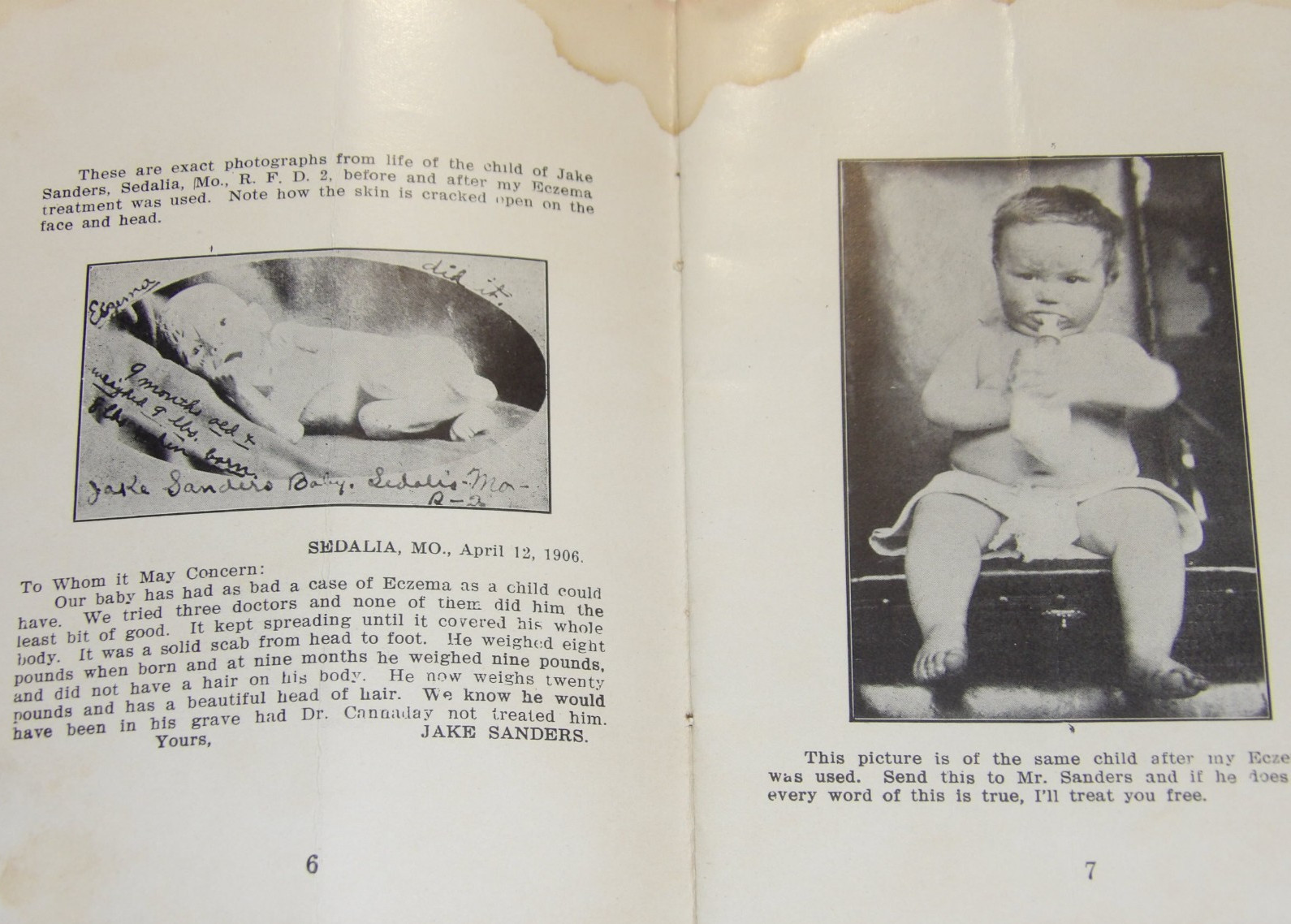 VINTAGE 1907 MEDICAL BOOKLET~ECZEMA TREATMENTS CURED IN WEEKS BEFORE & AFTER