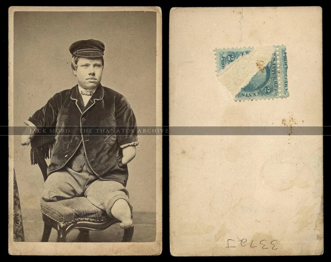 Texas Jack Sideshow Boy Very Rare Or One Of A Kind CDV Photo 1860s Tax Stamp
