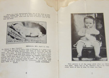 VINTAGE 1907 MEDICAL BOOKLET~ECZEMA TREATMENTS CURED IN WEEKS BEFORE & AFTER picture